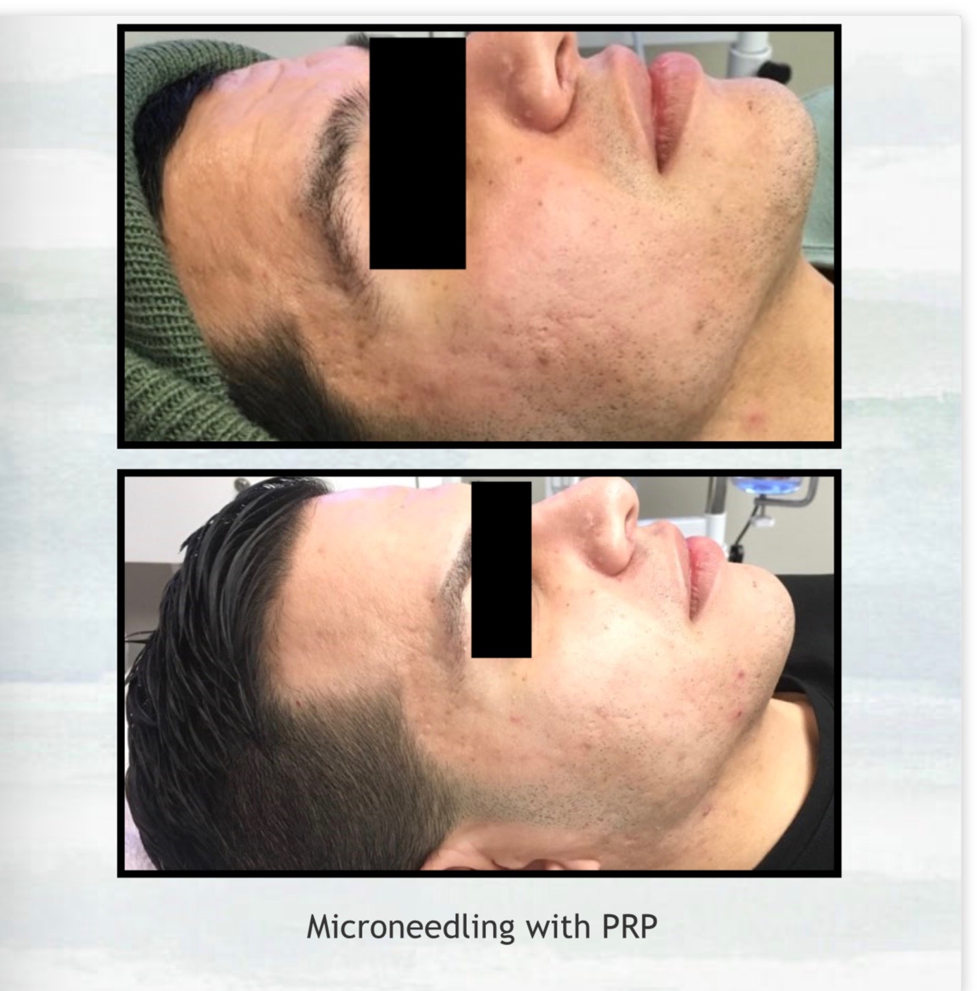 Microneedling with PRP Before and After of Client