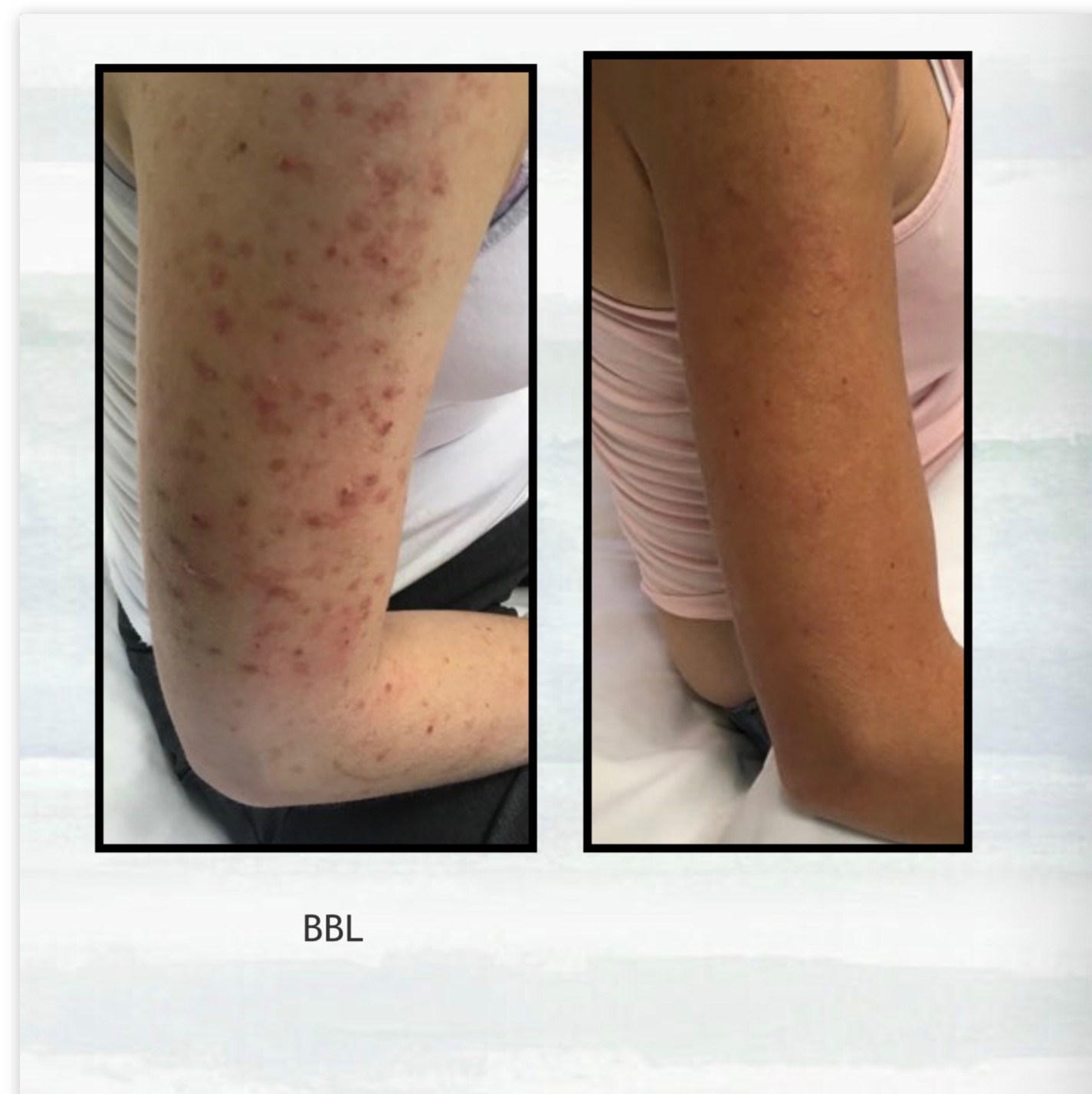 BBL Before and After of Client