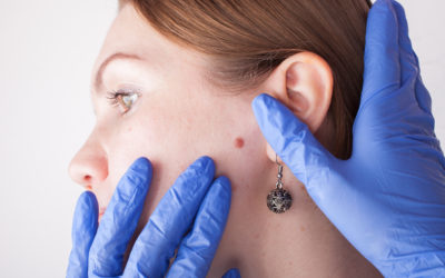 Why Skin Cancer Often Goes Undetected in Early Stages