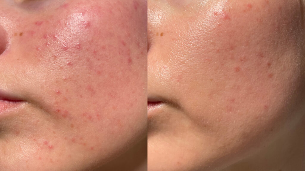 Microneedling with PRP Before and After of Client